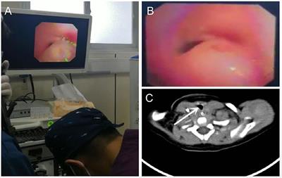 The application of classic laryngeal mask airway combined with a self-created adaptor in interventional bronchoscopy for pediatric patients: A case series and literature review
